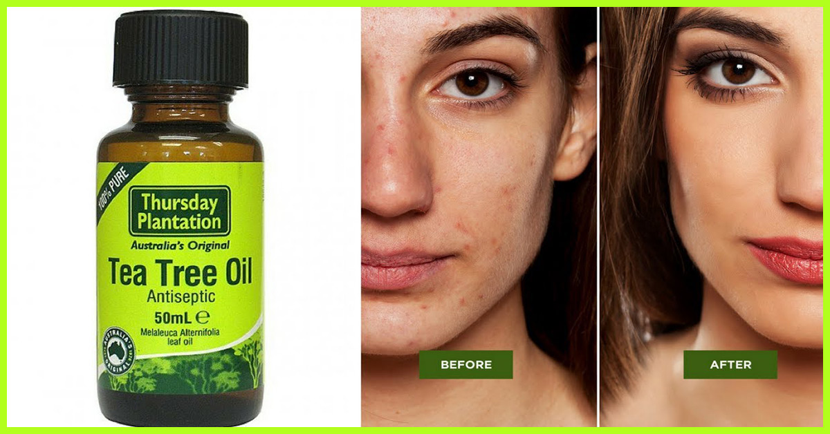 How to Use Tea Tree Oil for Acne Treatment Today?